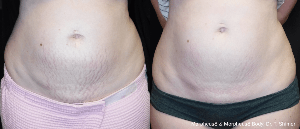 Morpheus8 sagging skin on stomach, Morpheus 8 before and after