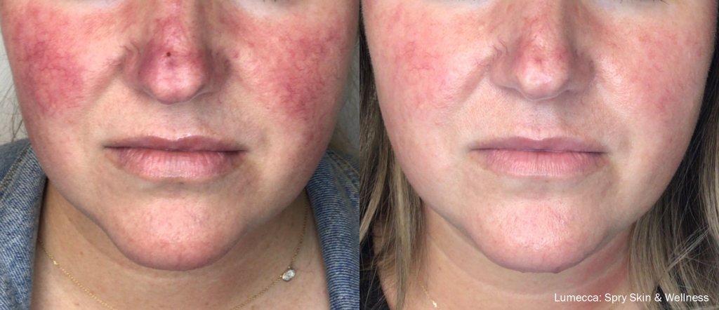 Lumecca IPL laser treatment skin on face, rosacea, pigmentation, spider veins, broken capillaries, laser vein removal, Lumecca before and after