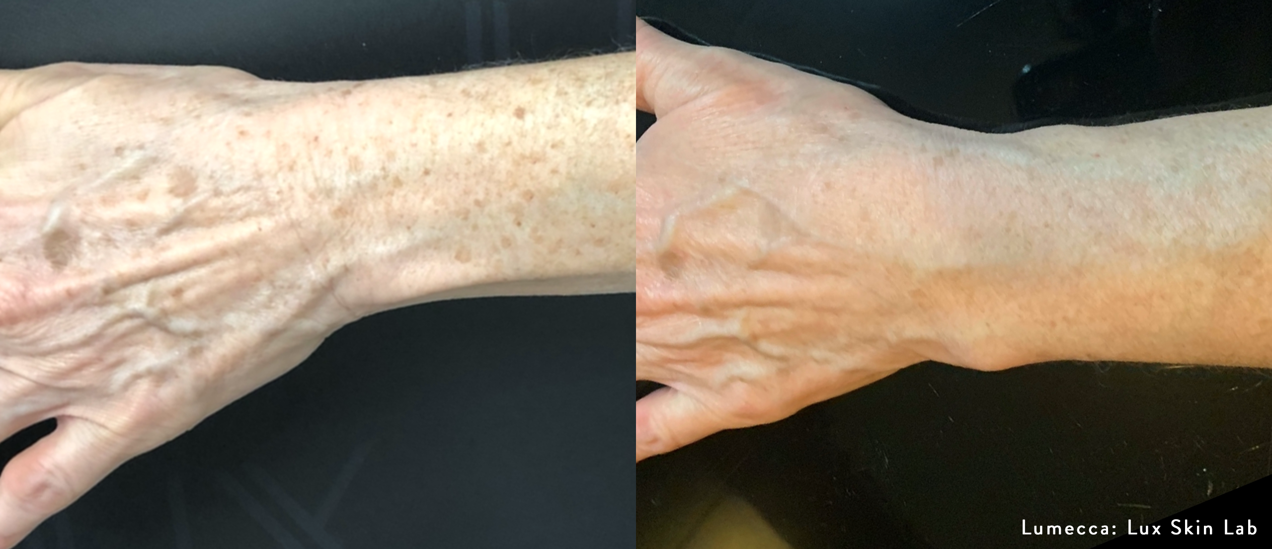Lumecca IPL laser treatment, hands, brown spots, sun spots, pigmentation, age spots, sun damage, Lumecca before and after